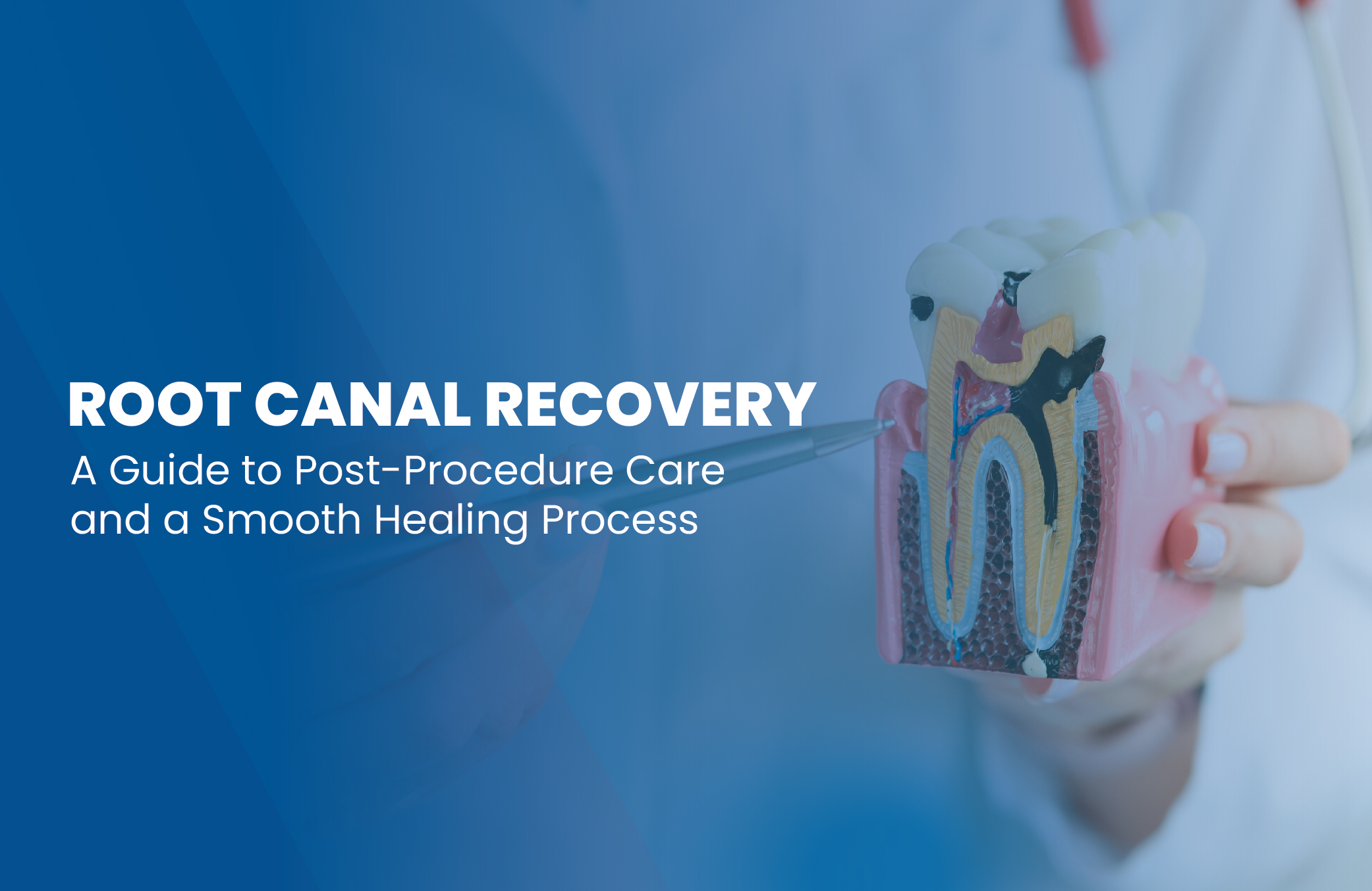 Root Canal Recovery